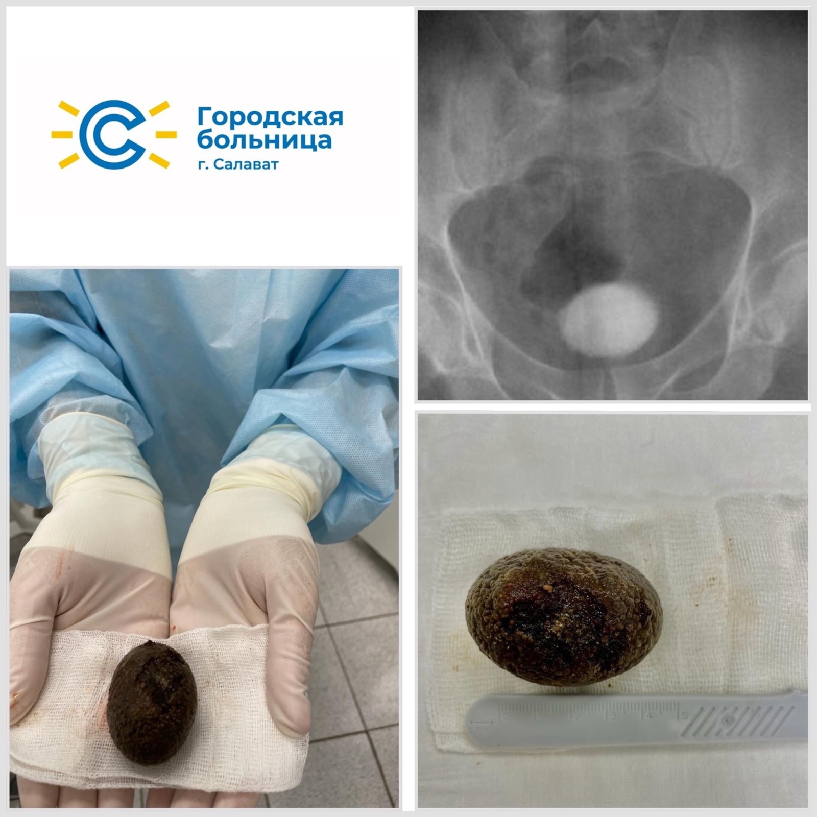 В Башкирии врачи успешно удалили из мочевого пузыря камень размером с куриное яйцо