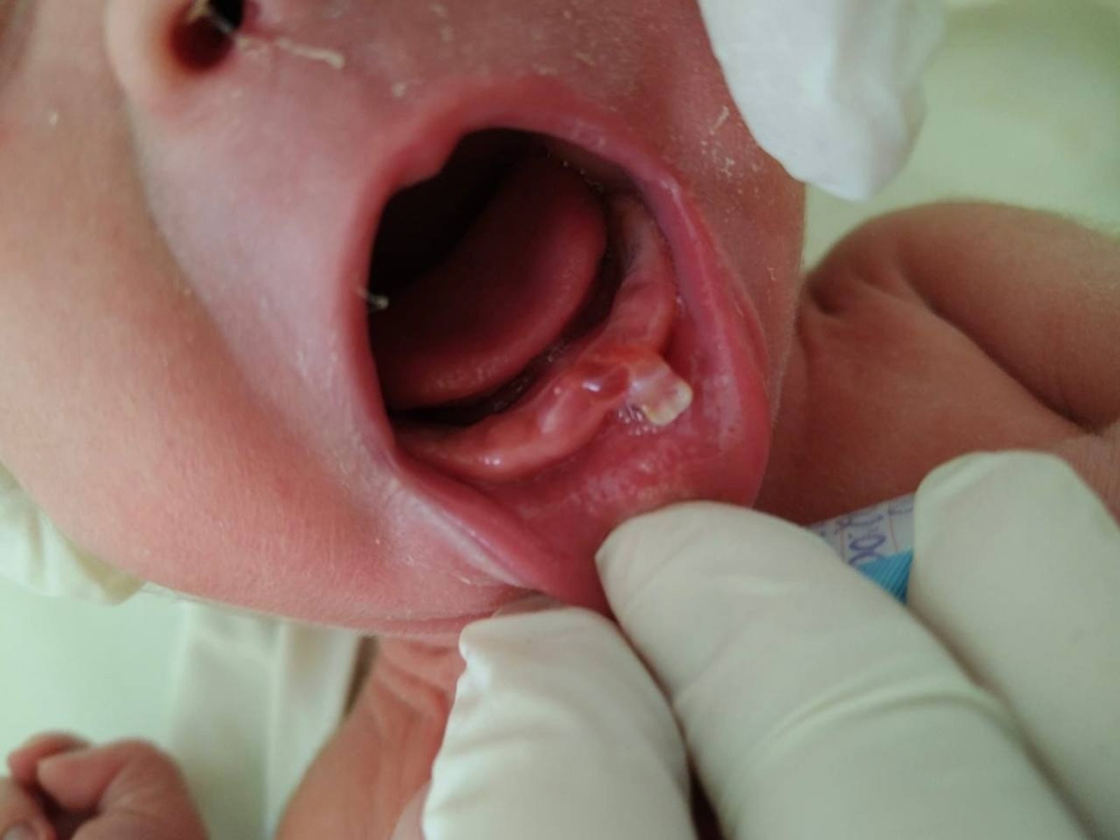 В Башкирии родился малыш с редкой патологией